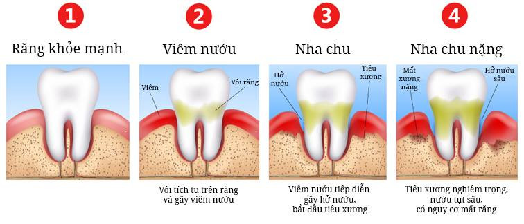 Viêm Nha Chu và Viêm Lợi: Phân Biệt và Cách Chữa như thế nào?